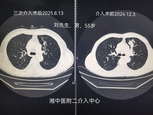 湖南中医药大学放射介入中心创新治疗模式显奇效(图1) 湖南中医药大学放射介入中心创新治疗模式显奇效(图1)